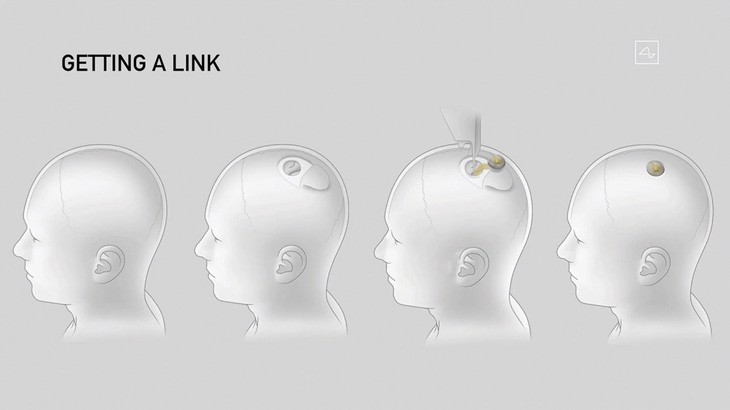 Hình minh họa quy trình cấy ghép chip vào não người của Neuralink. Ảnh: AFP