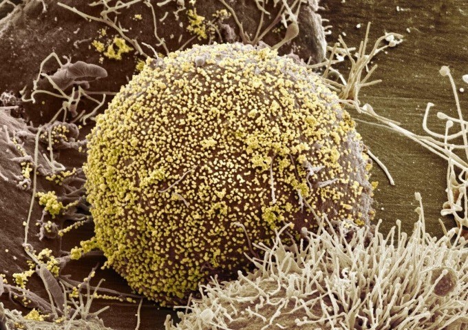Hình ảnh hiển vi các hạt virus HIV màu vàng đang lây nhiễm vào tế bào chủ. Ảnh: NCMIR