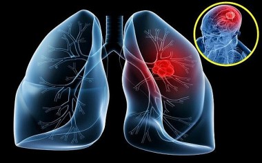 Tỉ lệ mắc mới ung thư phổi có xu hướng gia tăng