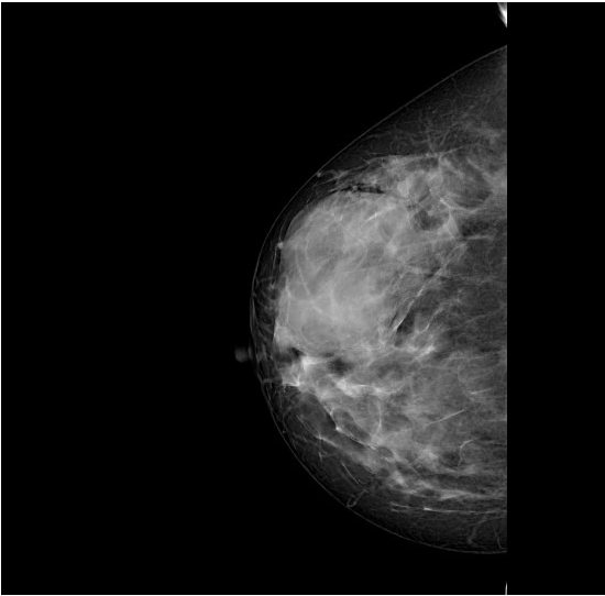 Hình ảnh chụp khối viêm trong tuyến vú bệnh nhân.