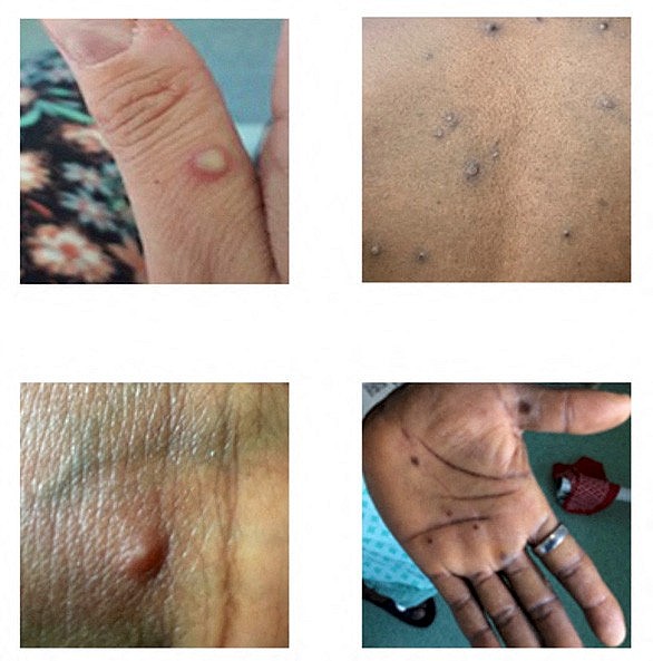 Những biểu hiện ngoài da của bệnh nhân bị đậu mùa khỉ - Ảnh: REUTERS
