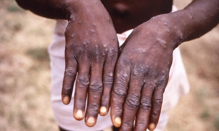 Bàn tay của một người bị tổn thương khi mắc virus đậu mùa khỉ. 