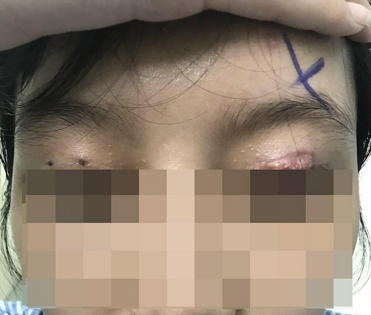 Cơ vùng mắt bị kéo lên khỏi vùng da, hoại tử, sưng tấy vì cắt mắt tại một cơ sở thẩm mỹ không phép. Ảnh: BVCC