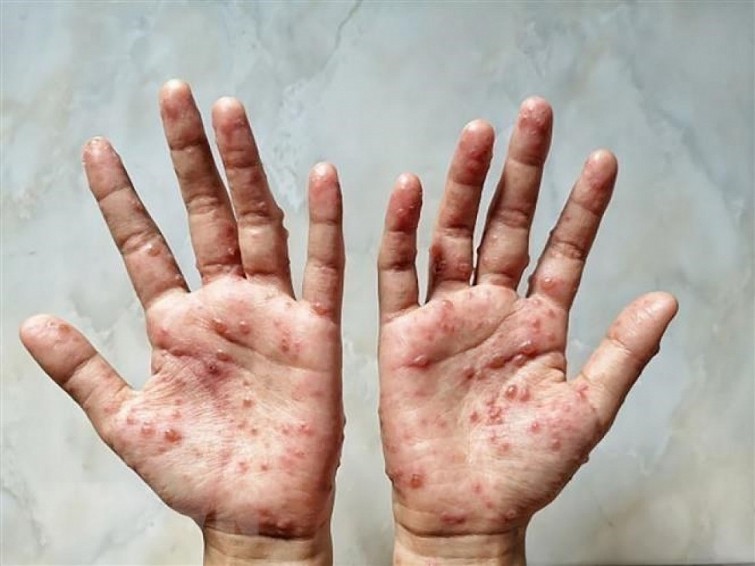 Các ban đỏ nổi trên tay một bệnh nhân mắc bệnh đậu mùa khỉ. Ảnh: Shutterstock