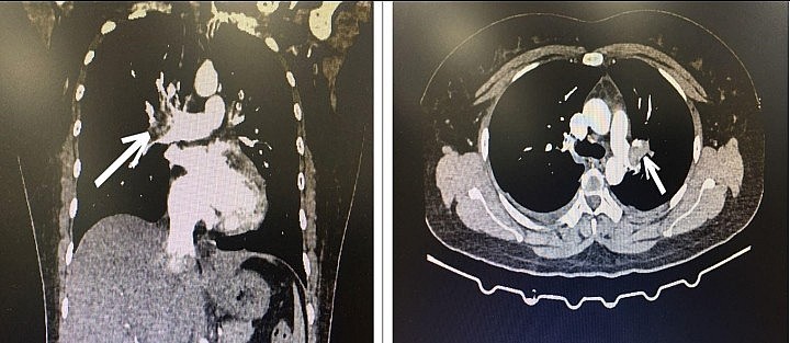 Hình ảnh CT lồng ngực bệnh nhân bị tắc động mạch phổi cấp tính. Ảnh: BVCC