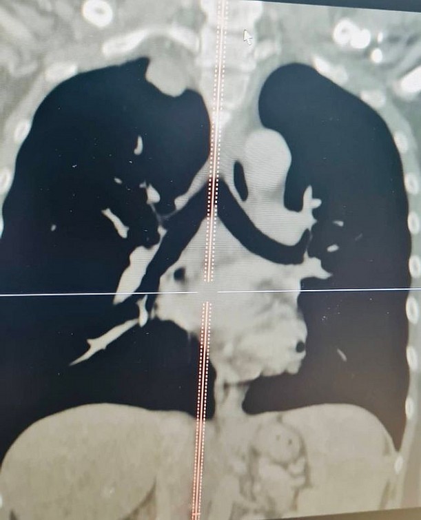 Hình ảnh khối u của bệnh nhân T. trên phim chụp cắt lớp vi tính và cộng hưởng từ.