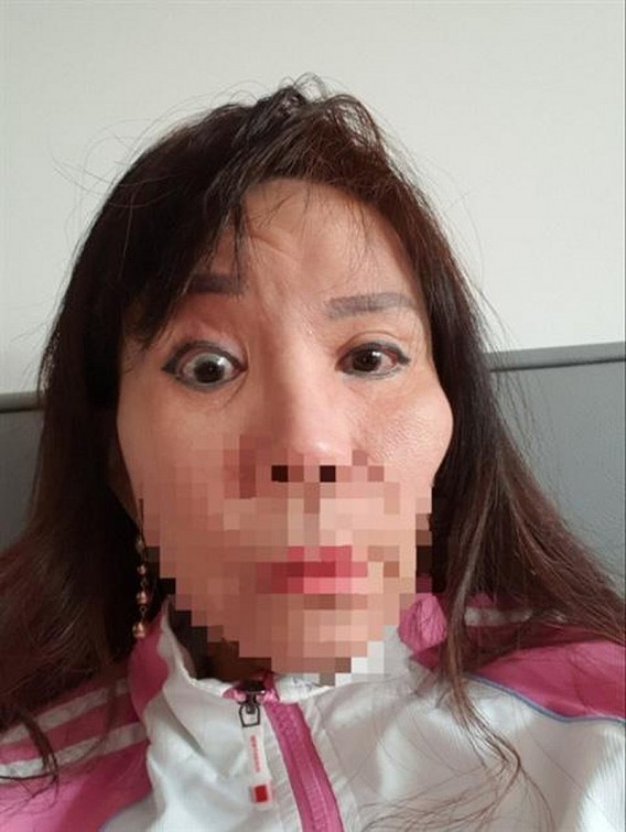 Bà Đ. bị biến dạng khuôn mặt sau khi phẫu thuật căng da mặt và cắt mí tại Kangnam.