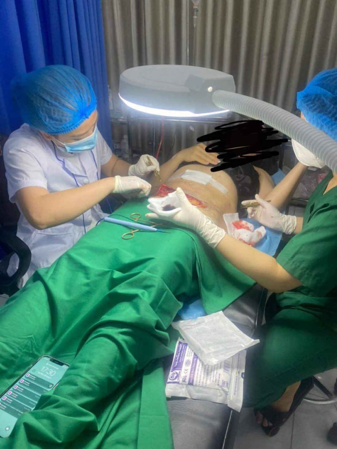 Hình ảnh nữ bệnh nhân được phẫu thuật hút mỡ tại cơ sở mạo danh Bệnh viện Đa khoa Hà Nội.