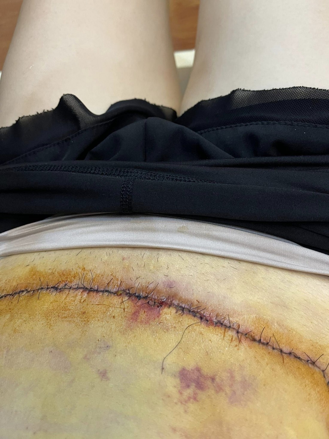 Vết mổ của nữ bệnh nhân sau khi làm phẫu thuật hút mỡ.