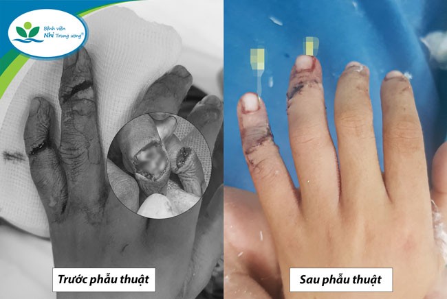 Hình ảnh ngón tay của trẻ trước và sau phẫu thuật 3 ngày. Ảnh: Bệnh viện Nhi Trung ương