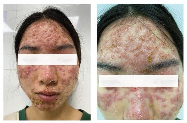 Cô gái bị tổn thương da sau khi điều trị trứng cá bằng cách đắp mặt, bôi kem 'detox' tại spa