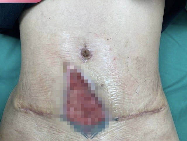 Hình ảnh biến chứng hoại tử, loét da nặng vùng bụng sau khi đi hút mỡ bụng tại một spa của bệnh nhân kể trên(Ảnh: BSCC)