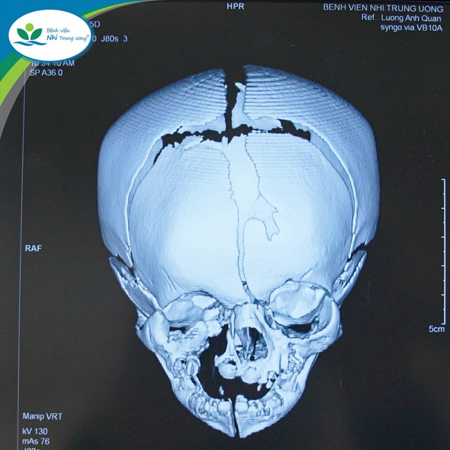 Hình ảnh chụp cắt lớp vi tính sọ mặt của bé B.A. Ảnh: Bệnh viện Nhi Trung ương